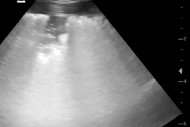 Suspect early OPA lesion