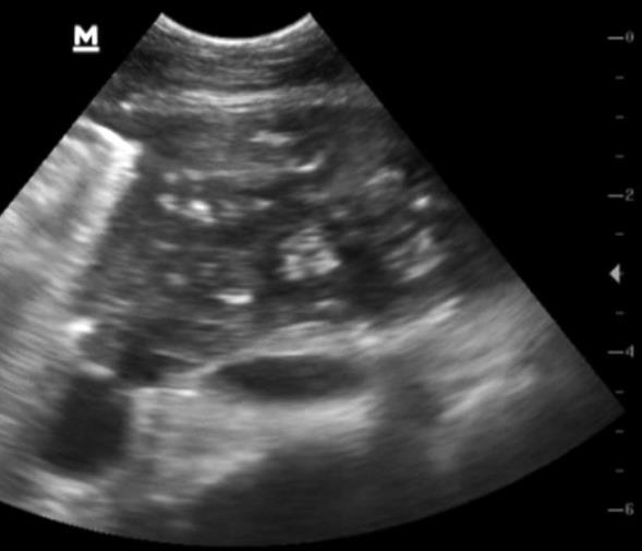 OPA misdiagnosis