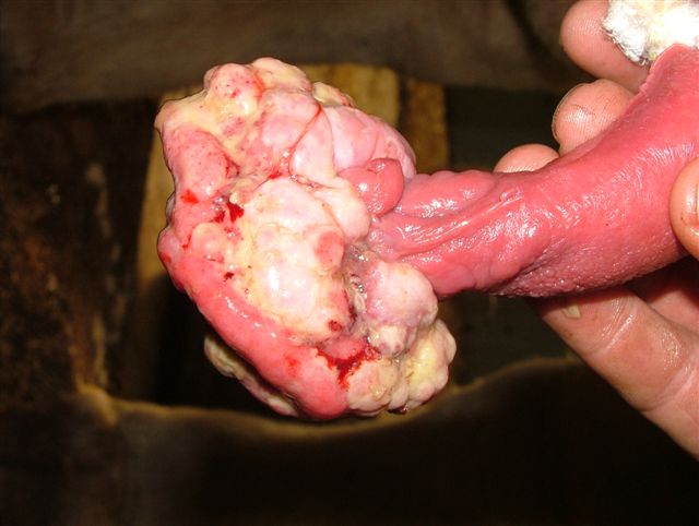 10 penile papillomas