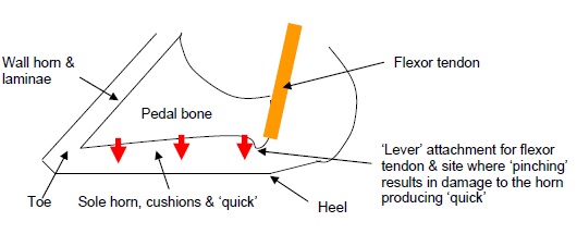 Sole ulceration