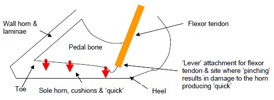 Sole ulceration